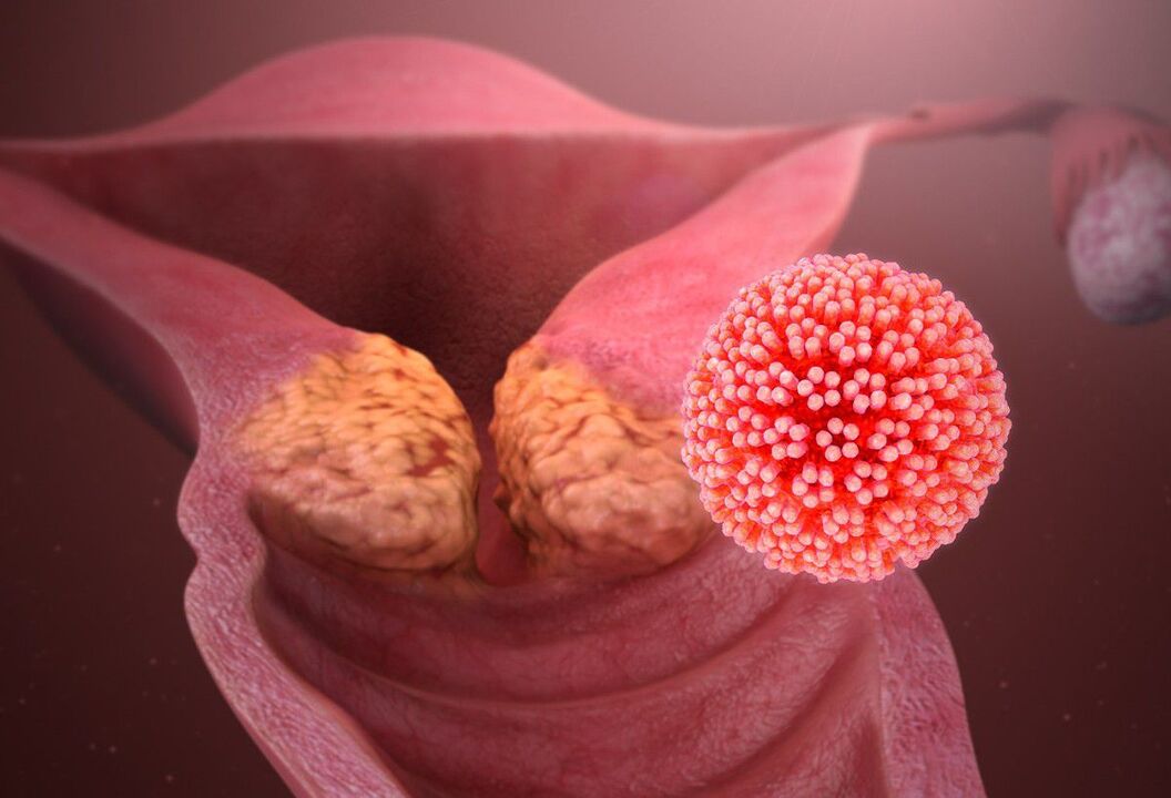 HPV-Läsion des Gebärmutterhalses