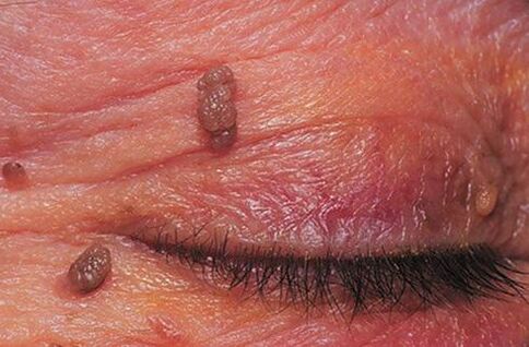 Papillome auf der Haut der Augenlider, die eine Behandlung erfordern