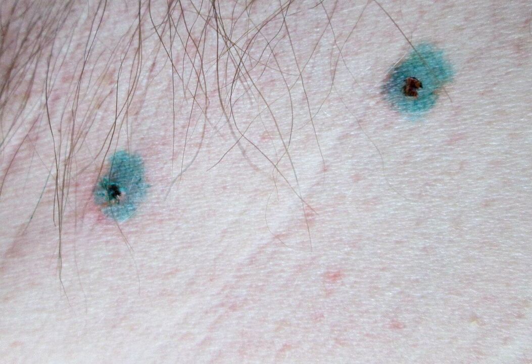 Flecken auf der Haut nach Laserentfernung von Papillomen